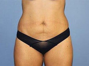 Tummy Tuck Before & After