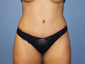 Tummy Tuck Before & After