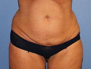 Tummy Tuck Before & After