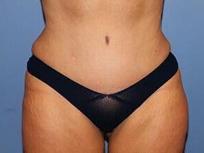 Tummy Tuck Before & After