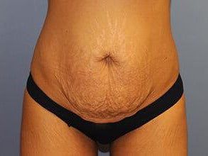 Tummy Tuck Before & After