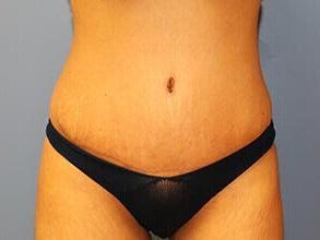 Tummy Tuck Before & After