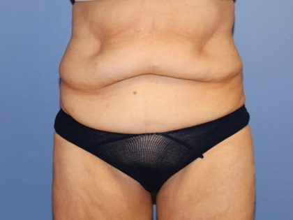 Tummy Tuck Before & After