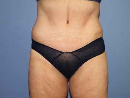 Tummy Tuck Before & After