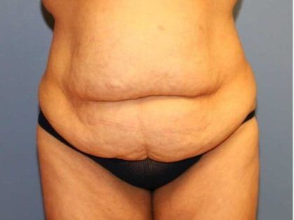 Tummy Tuck Before & After