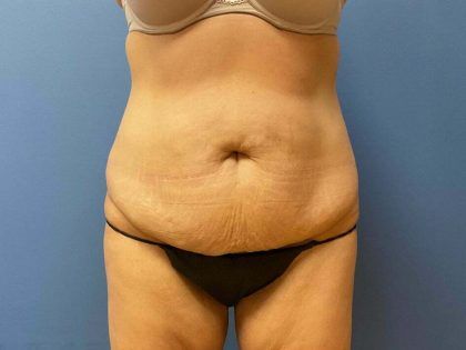 Tummy Tuck Before & After