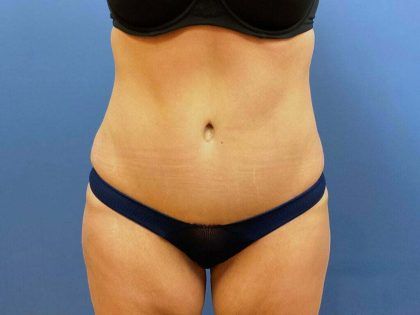 Tummy Tuck Before & After