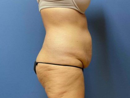 Tummy Tuck Before & After