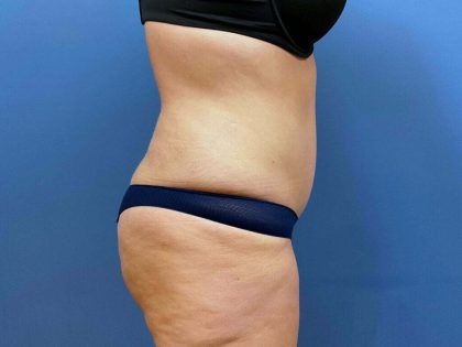 Tummy Tuck Before & After