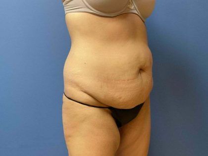 Tummy Tuck Before & After