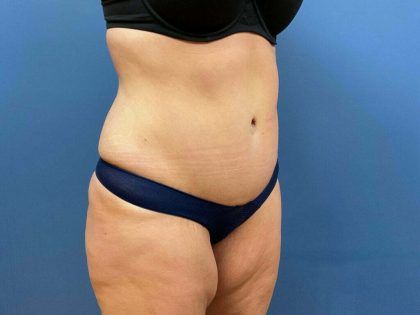 Tummy Tuck Before & After