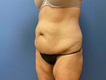Tummy Tuck Before & After
