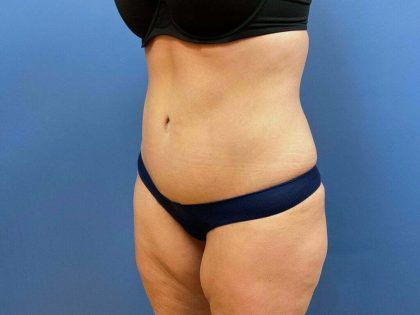Tummy Tuck Before & After