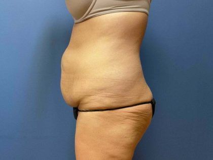 Tummy Tuck Before & After