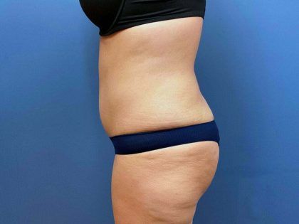 Tummy Tuck Before & After