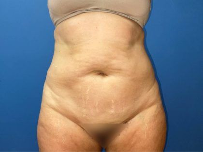 Tummy Tuck Before & After