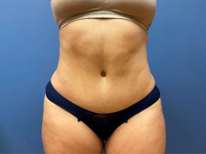 Tummy Tuck Before & After