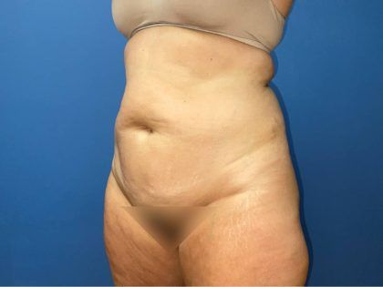 Tummy Tuck Before & After