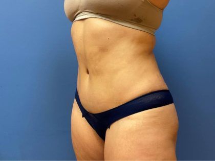 Tummy Tuck Before & After