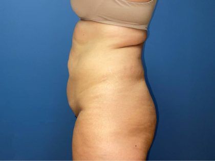 Tummy Tuck Before & After