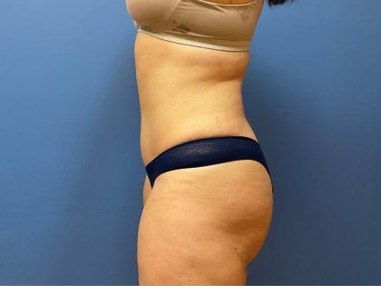 Tummy Tuck Before & After