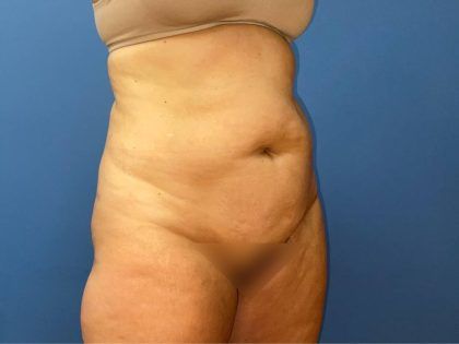 Tummy Tuck Before & After