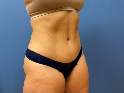 Tummy Tuck Before & After