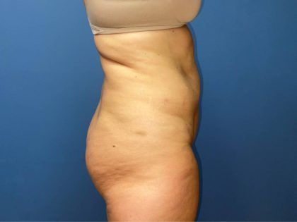 Tummy Tuck Before & After
