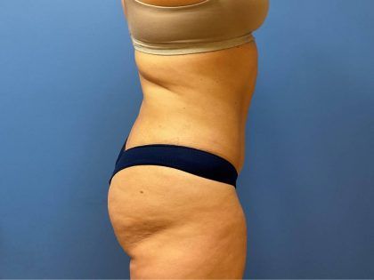 Tummy Tuck Before & After