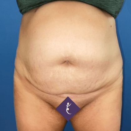 Tummy Tuck Before & After