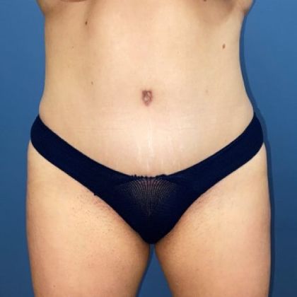 Tummy Tuck Before & After