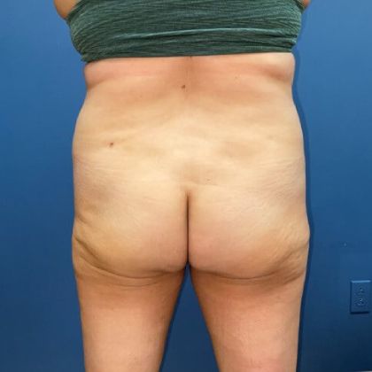 Tummy Tuck Before & After