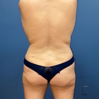 Tummy Tuck Before & After
