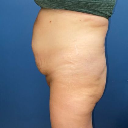 Tummy Tuck Before & After