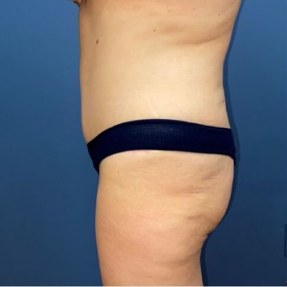 Tummy Tuck Before & After