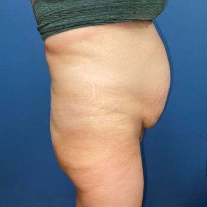 Tummy Tuck Before & After