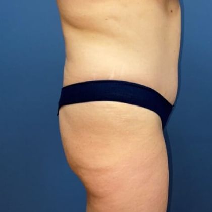 Tummy Tuck Before & After