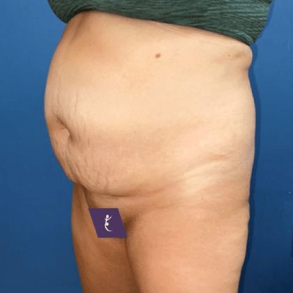 Tummy Tuck Before & After