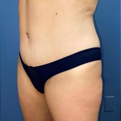 Tummy Tuck Before & After