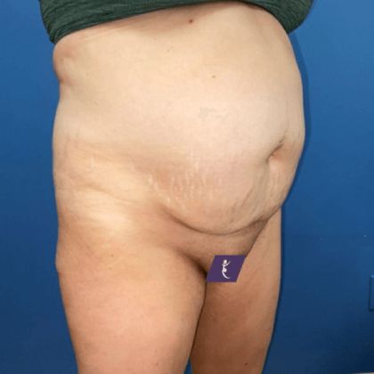 Tummy Tuck Before & After