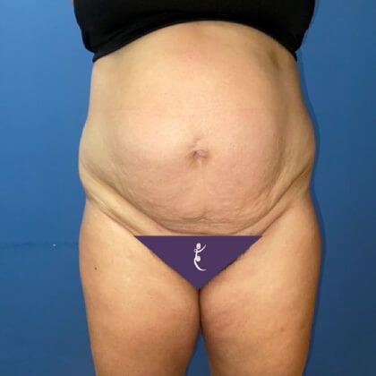 Tummy Tuck Before & After