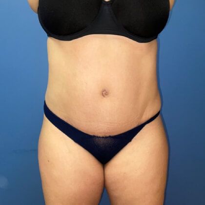 Tummy Tuck Before & After