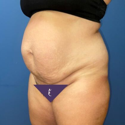 Tummy Tuck Before & After