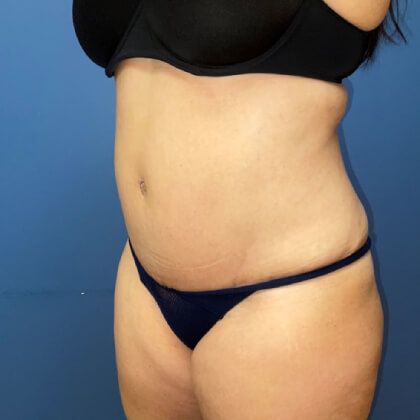 Tummy Tuck Before & After