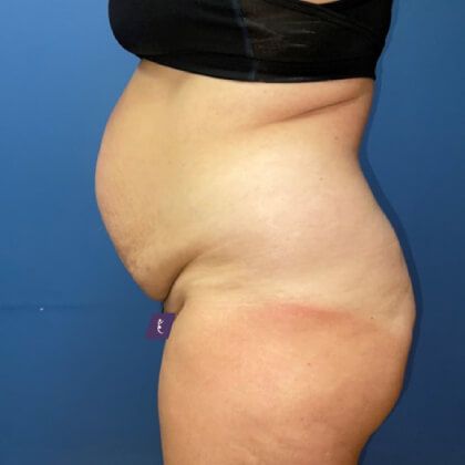 Tummy Tuck Before & After