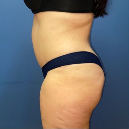 Tummy Tuck Before & After