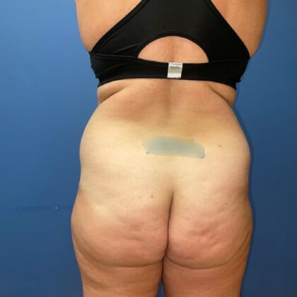 Tummy Tuck Before & After