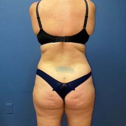 Tummy Tuck Before & After
