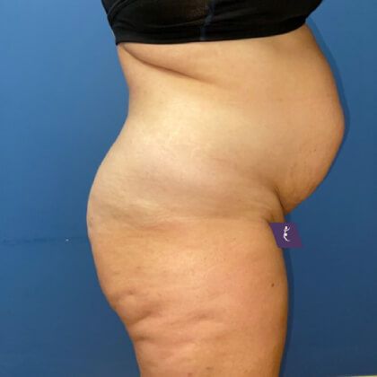 Tummy Tuck Before & After