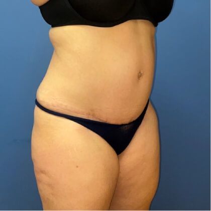 Tummy Tuck Before & After
